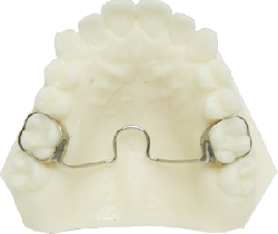 Transpalatal Arch