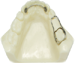 Bonded Retainer