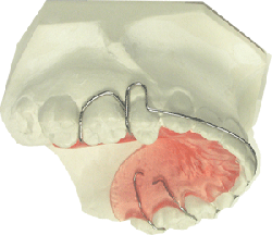 U-Hawley C Clasp